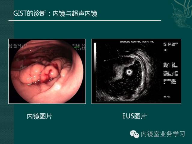 什么是间质瘤